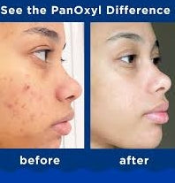 PanOxyl Acne Creamy Wash 4% Benzoyl Peroxide - Daily Control Cleanser 170g